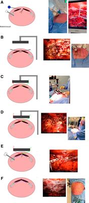 Case Report: Intraoperative Fascial Traction in Robotic Abdominal Wall Surgery; An Early Experience